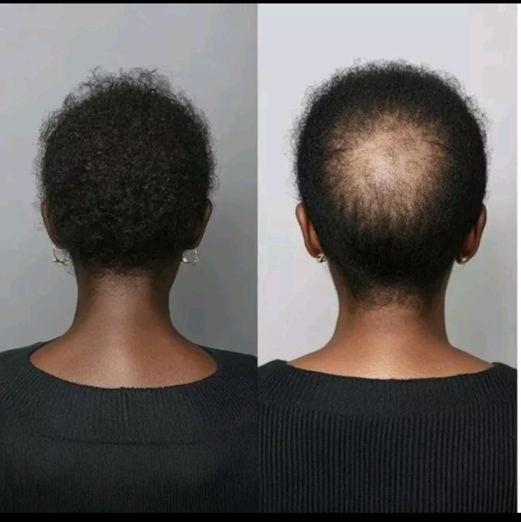 *:New Crown naturale Electric Scalp Massager Hair Oil Applicator Brush Red Light - Picture 14 of 16